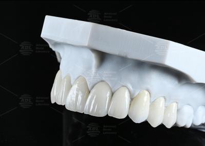 Translucency CAD EMAX Veneer Polished Glazed Ceramic Restorations For Anterior Posterior Areas