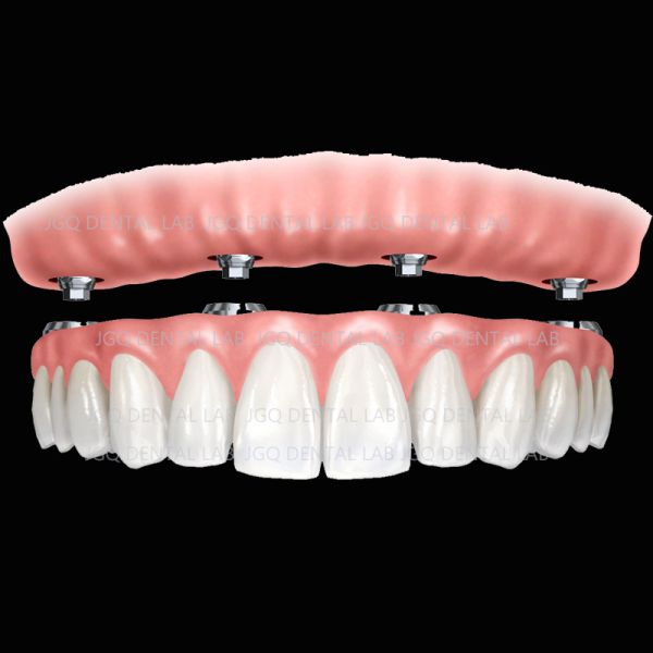Full Mouth Dental Implant Bridge Customized Implanting Guide For Oral Restoration