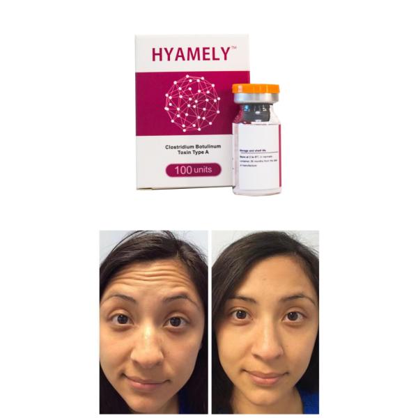 Tipo da toxina de Botulium unidades de uma injeção 100 do pó dos enrugamentos de Botox anti