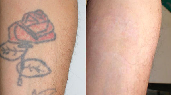 Pigments Freckle Removal Q Switch Yag Laser Machine / Nd Yag Laser System