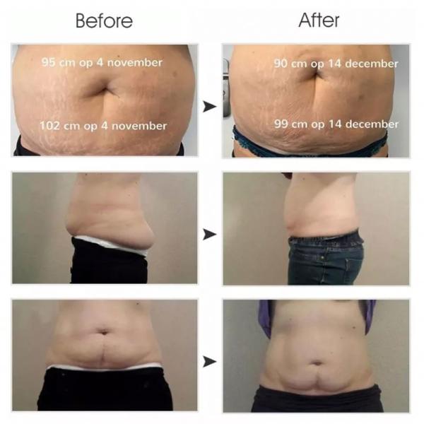 Super product standing cool slimming cellulite reduction cool tech fat freezing slimming criolipolisis machine