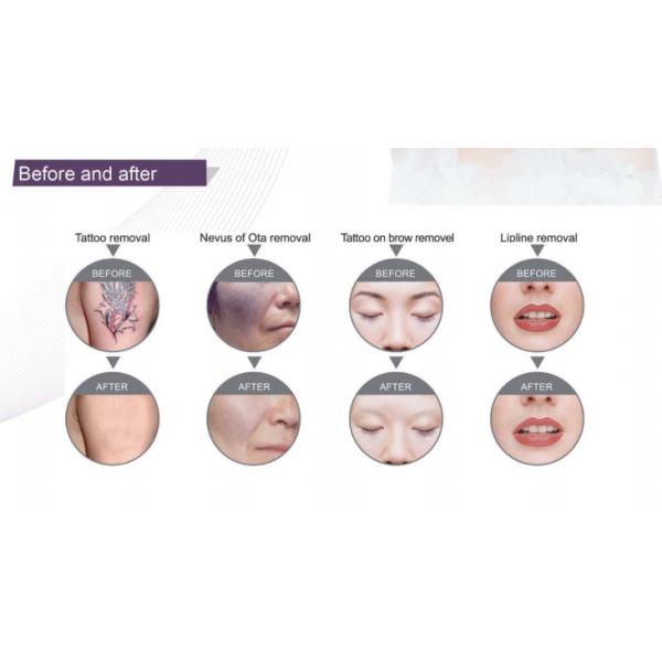 1-10HZ Frequency Q Switched Nd Yag Laser For Pigmentation / Laser Tattoo Removal Equipment