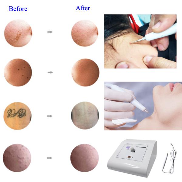 Sterilization Multifunctional Facial Machine Dark Spot Electro Cautery Skin Wart Remover Machine