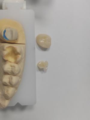 Long Lasting Restorations Dental Inlay Onlay Superior Strength And Durability