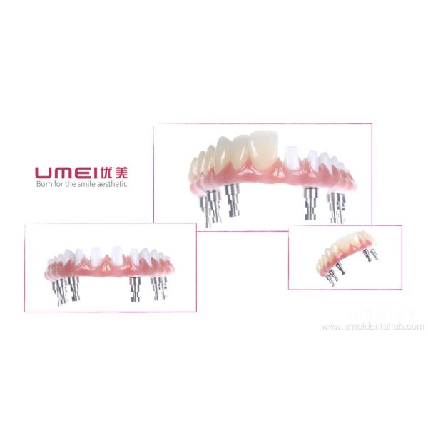 Full Arch Zirconia Malo Bridge