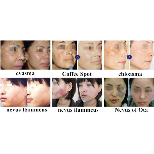 2017 Newest design tattoo removal/freckle removal/birth mark removal/hair remove/vascular remove Q Switched Nd Yag Laser