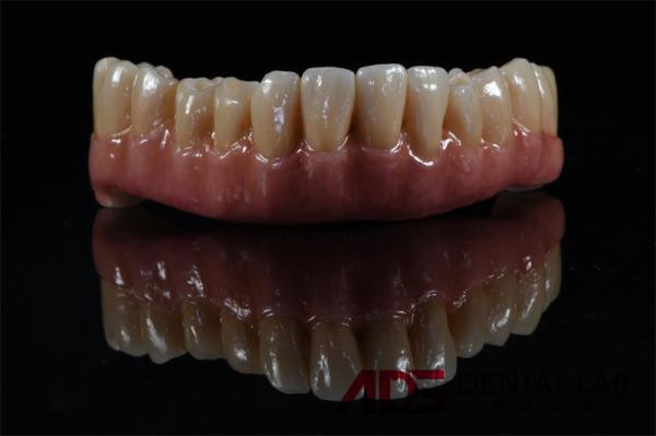 Titanium Zirconia Implant Supported Dental Bridge All On 4 6