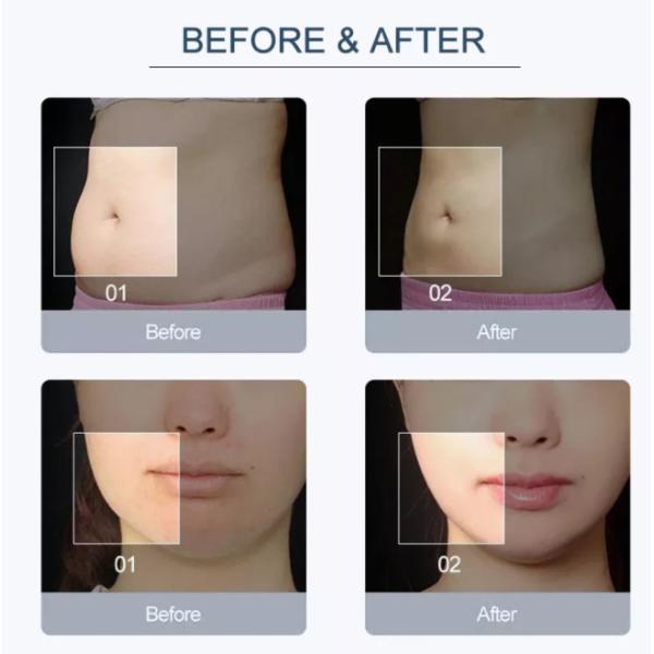 2024 Newest Endolaser 1470nm 980nm Diode Laser Face Lifting Liposuction Machine