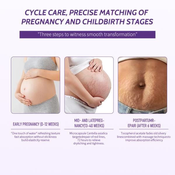 Nano Transdérmico Cuidado de la piel del embarazo Línea de estiramiento Marca de reparación de tratamiento de la crema