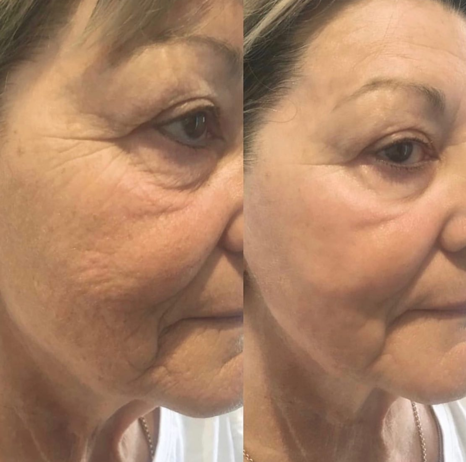 Тело уменьшая удаление морщинки кожи удаления жировых отложений Exilis RF поднимаясь