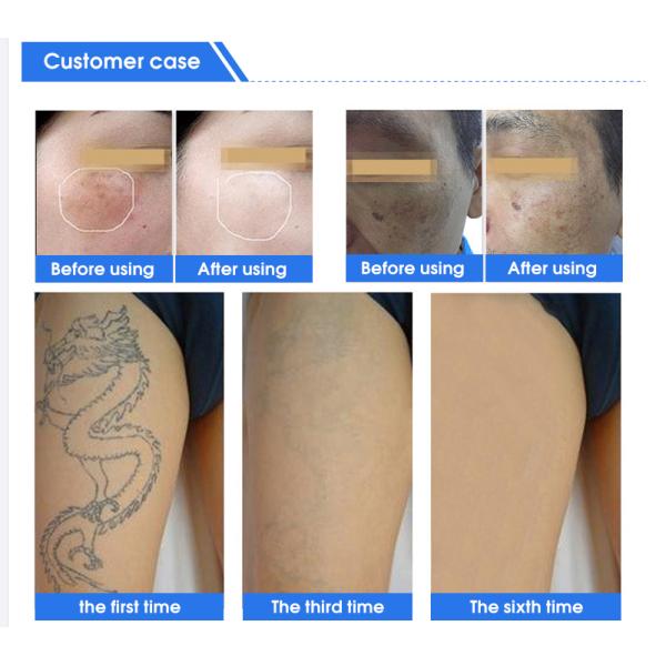 1064nm 532nm 1320nm Professional Laser Tattoo Removal Machine 500w Power