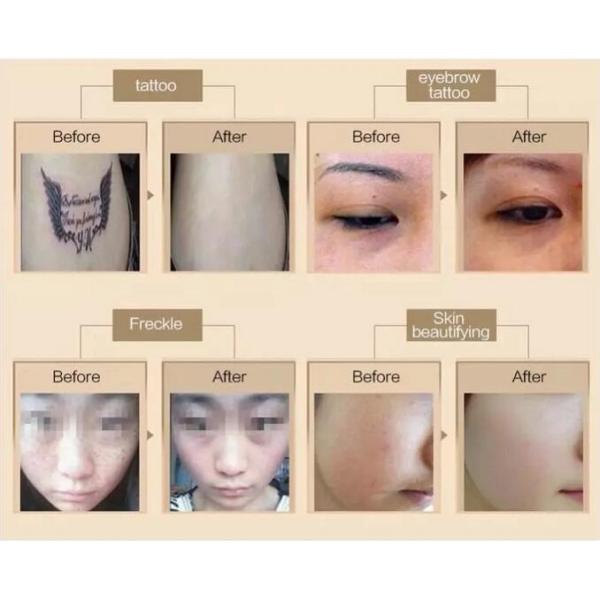 Professional Nd Yag Laser Tattoo Removal Machine Stationary Type For Hospital