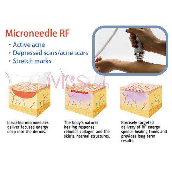 los pernos del balneario 4MHz 10 pelan para apretar la máquina micro del Rf de la aguja