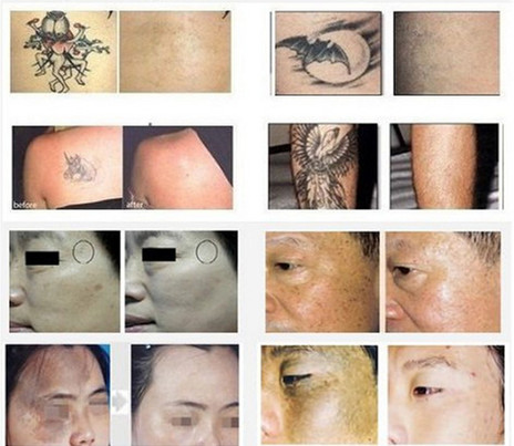 Portble ND YAG Laser Tattoo Removal Machine 1064nm / 532nm Laser Machine