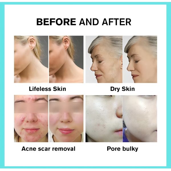 Multi Wavelength ABS PDT Beauty Machine For Facial Treatment / Wellness Centers