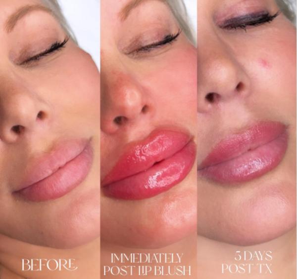 Skinject Deep Hyaluronic Acid Dermal 2ml Lips Fillers Injectable