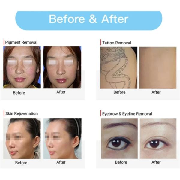 4 длины волны лазерная машина для удаления татуировок Пикосекунды для удаления пор