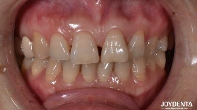 0Épaisseur de.5 mm Faisceaux dentaires en céramique naturels à la recherche d'indications sur les dents antérieures