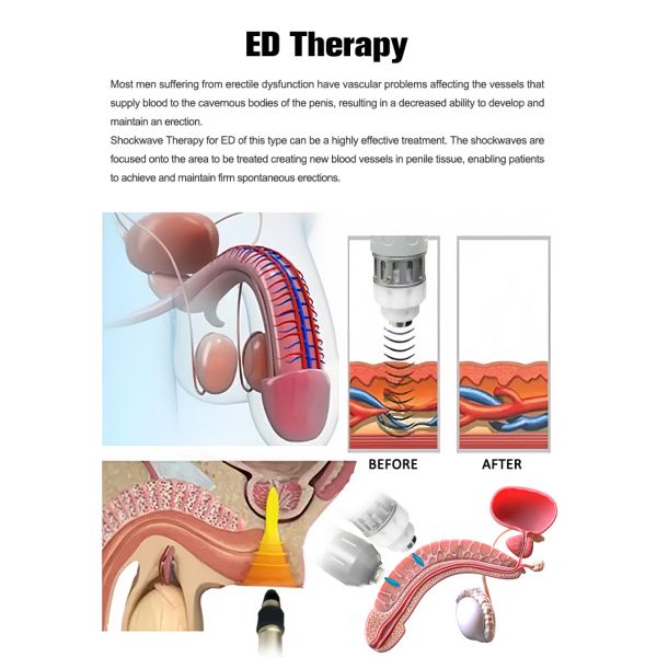 Shockwave Therapy Machine with Dual Handle Design for Targeted Treatment of Knee Pain Cellulite and Soft Tissue Injuries