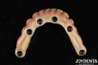 Durable Dental Aesthetic Titanium Malong Hybrid Bridge For Care