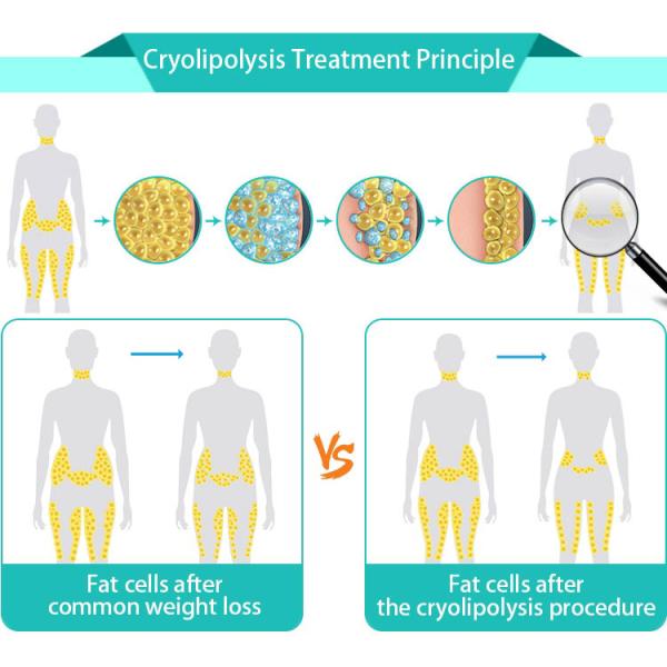 Medical CE approved 4 handles cryotherapy fat reduction with double chin removal
