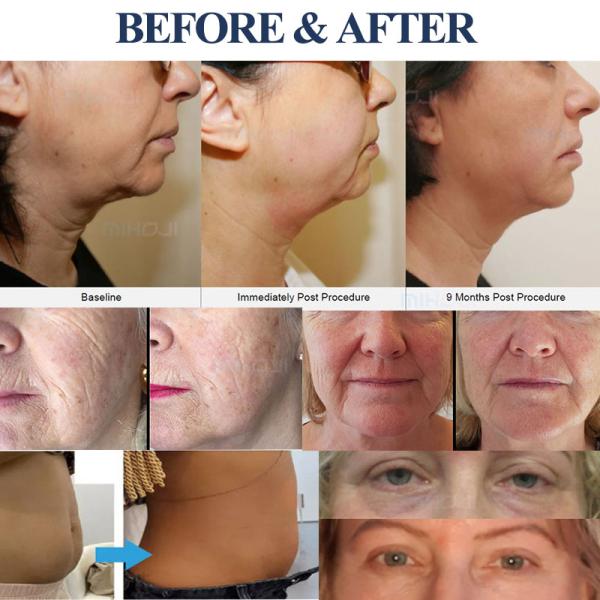 Профессиональный Hifu Beauty Machine 12D Антивозрастная Ультразвуковая красота лица