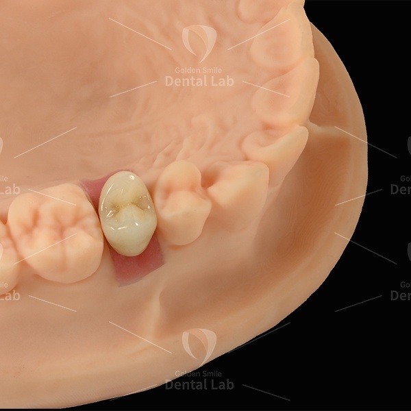 Cement Retained Zirconia Implant Crown And Bridge Dental Lab