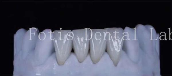 Polishing Finishing Cosmetic Teeth Veneer Covers  For Beautiful Smile