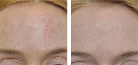 Pixel CO2 Vaginal Rejuvenation Machine , Laser Skin Treatment Equipment