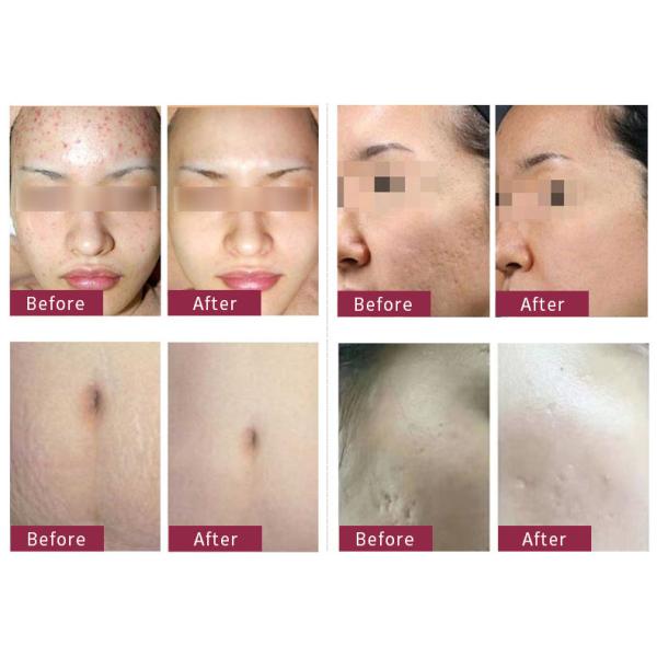 машина подмолаживания машины 60W лазера СО2 400mj частичная влагалищная