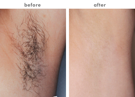 Безболезненная машина удаления волос лазера диода 808nm, оборудование обработки удаления волос лазера