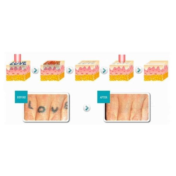 3 In 1 Nd Yag Laser IPL SHR Hair Removal Machine Vascular Treatment Body Slimming