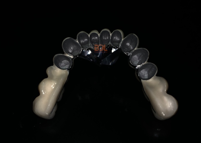 Custom Porcelain Fused To Metal Crown Designed To Provide Long Term Stability And Natural Look Ideal For Professional Dental