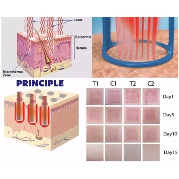 Mini Co2 pixel fractional laser Machine medical equipment For Deep Scar , Acne Removal