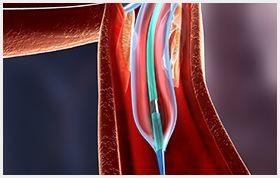 PTCA Balloon Catheter/RX PTFE coated/Hydrophilic coating/ Lesion Crossing/0.016