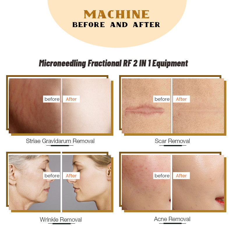 Радиочастота машины 5MHZ Microneedle RF подмолаживания кожи частичная
