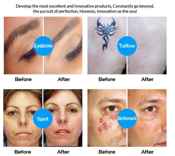 Multi Functional Q Switched Nd Yag Laser Tattoo Removal Machine Stationary Type