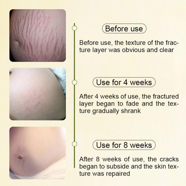 Natural Moisturizing Pregnancy Skincare Line Belly Cream, Butter For Breastfeeding Mothers