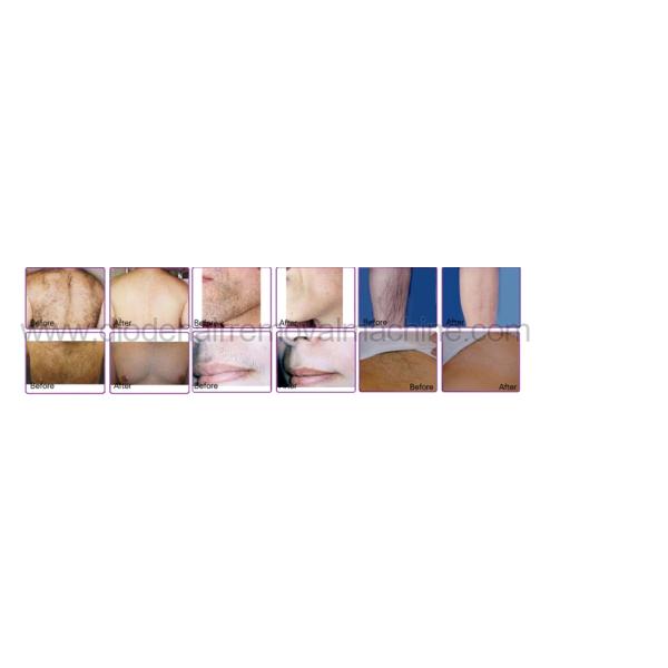 Stable Output 808 Laser Hair Removal Device Beauty Salon Equipment ISO13485