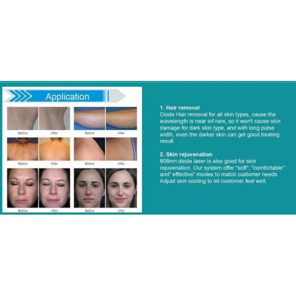 Permanent Hair Removal Devices , High Power Diode Hair Removal Laser Machine