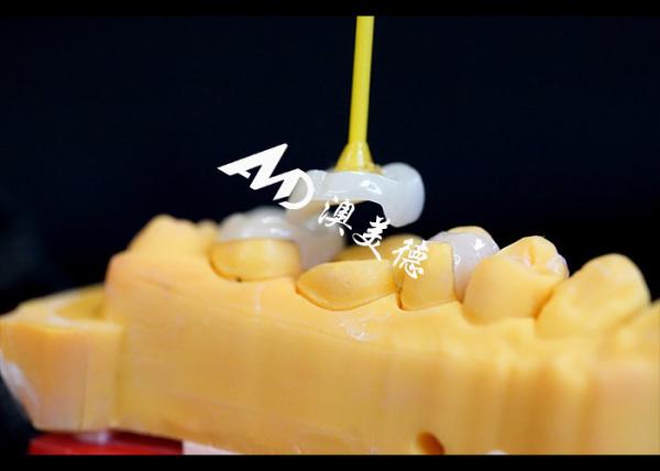 Cor Natural Precisão Inlays Cerâmicos Onlays Dentes Hipoalergênicos
