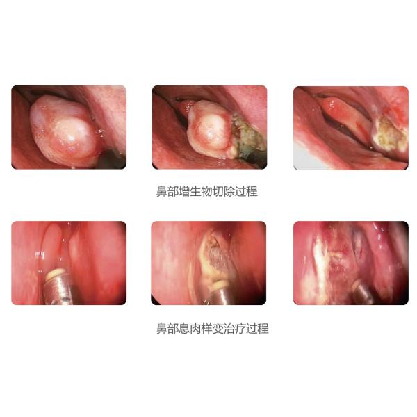 РЧ плазменный хирургический коблатор для тонзилектомии и аденоидектомии