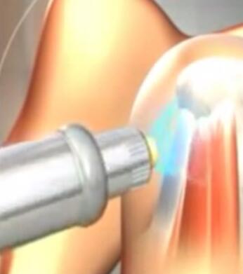ESWT pain relief shoulder joint tendons shockwave treatment physiotherapy radial shock wave equipment