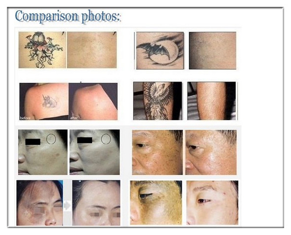 Vertical Skin Treatment Equipment Q Switched ND YAG Laser For Melasma