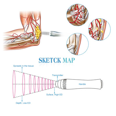 Electronic Shockwave Therapy Equipment Knee Arthritis Symptom Therapy 1 - 16HZ