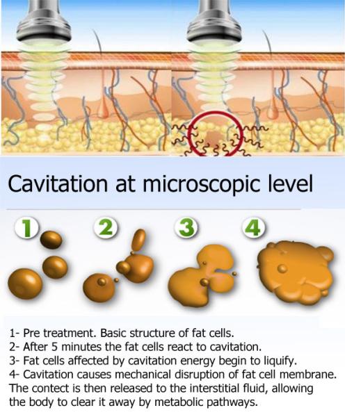 5 In 1 Multifunctional 40k 80k Vacuum Cavitation System Rf Lipo Laser Weight Loss Machine