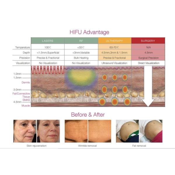 5 In 1 Smas Face And Neck Lift HIFU High Intensity Focused Ultrasound Machine