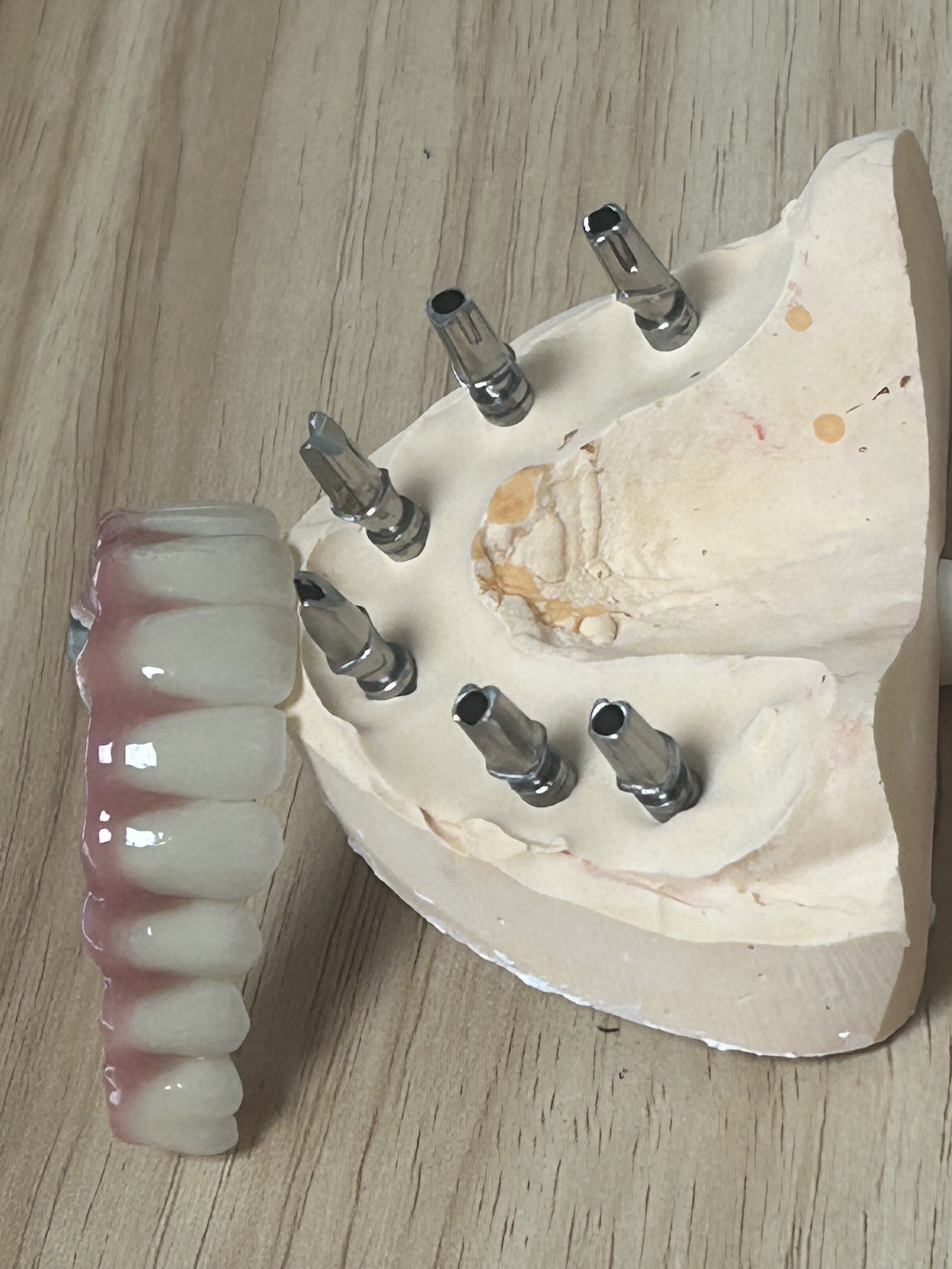 High-Strength Dental Zirconia Implant Crown with Natural Translucency & Tooth-Like Appearance via Digital CAD/CAM