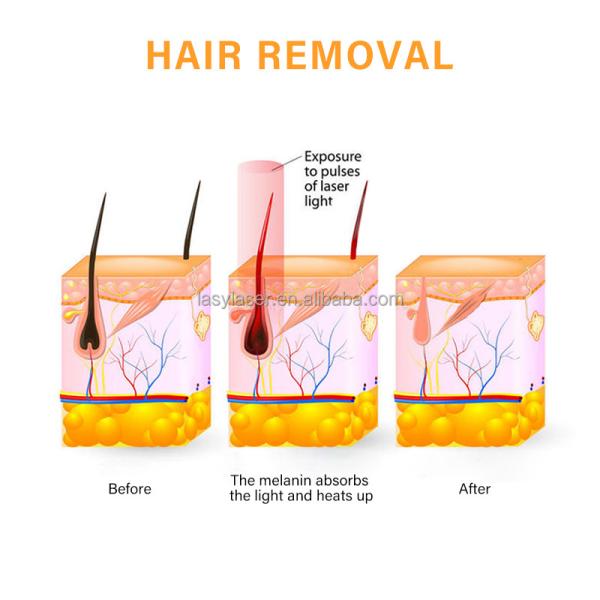 Rechargeable VCA Professional Diode Laser Hair Removal Machine Multifunctional 808nm