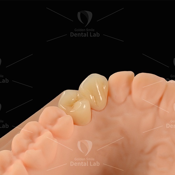 E Max Bridge Emax Laminate Veneers Lithium Disilicate Glass Ceramic Material